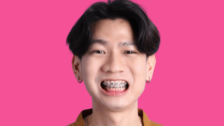 Cheapest Braces in Singapore for Students: A Complete Guide
