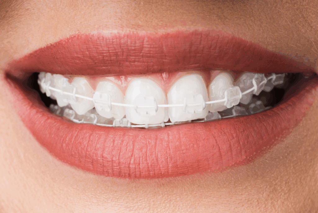 Cheap Ceramic braces in Singapore