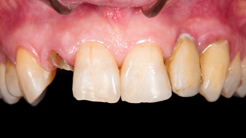 Cracks or fractures in the tooth