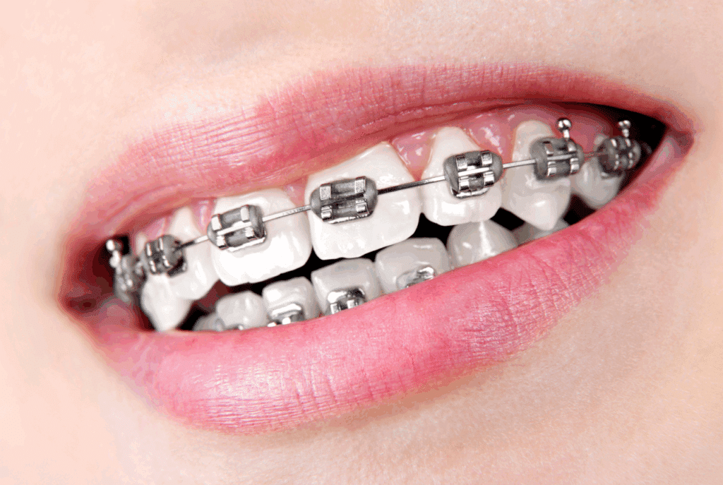 Cheap Self-ligating braces in Singapore
