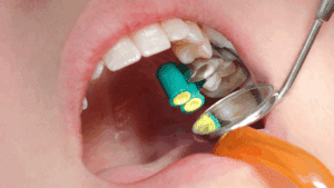 Endodontist Singapore