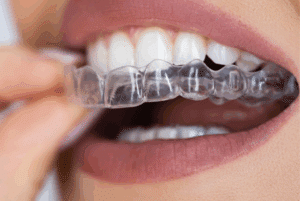 Cheap Clear Aligners (e.g. Invisalign) in Singapore