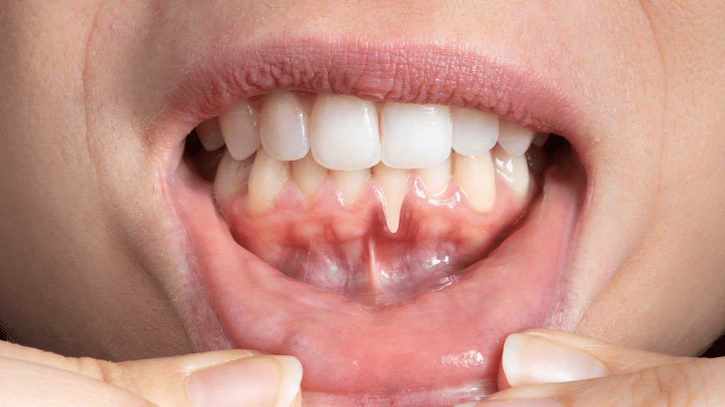 Advanced gum disease spreading to the tooth root