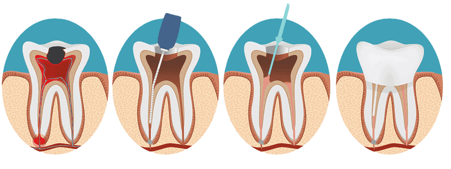 Root Canal Treatment Procedure