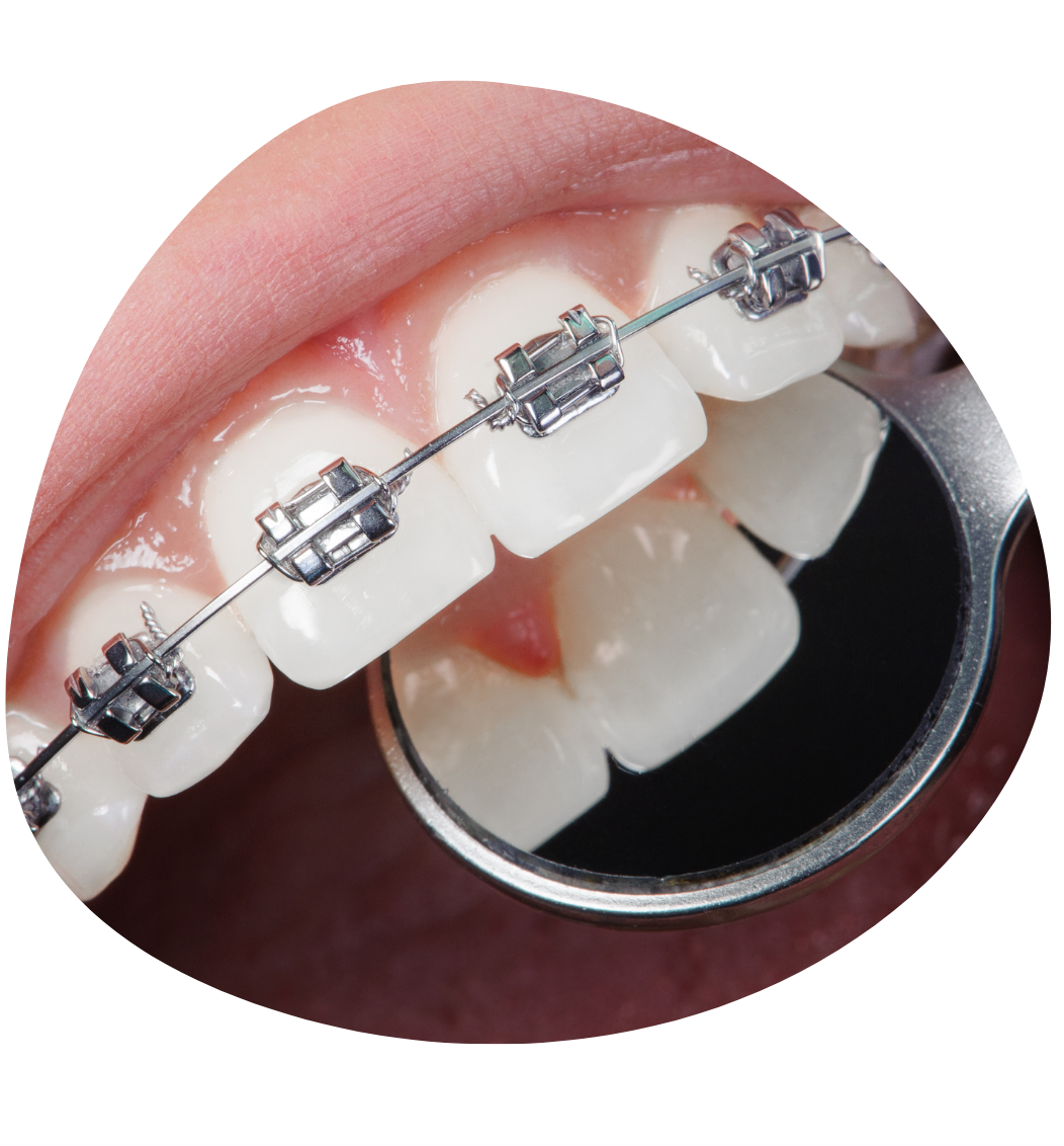 Cheap Braces in Singapore