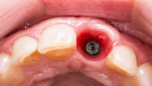 How long do dental implants take to heal? Your complete guide
