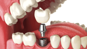 How long do dental implants take to heal? Your complete guide