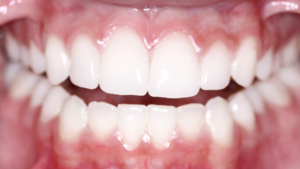 Topical fluoride treatment Singapore