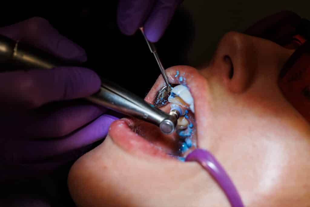 Topical fluoride treatment Singapore