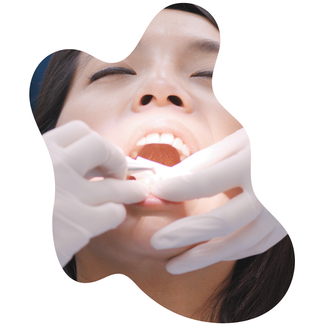 Teeth Scaling and Polishing