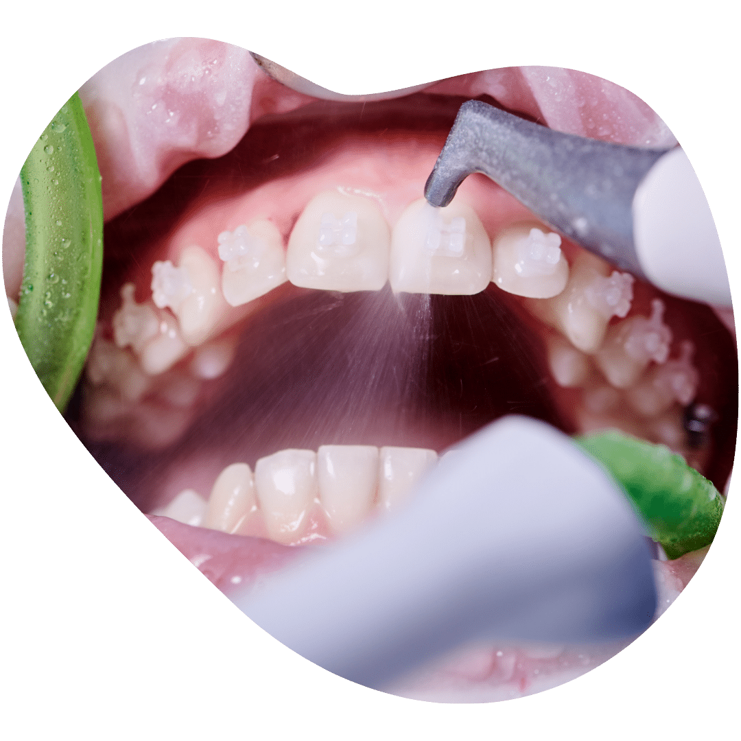 Scaling and Polishing