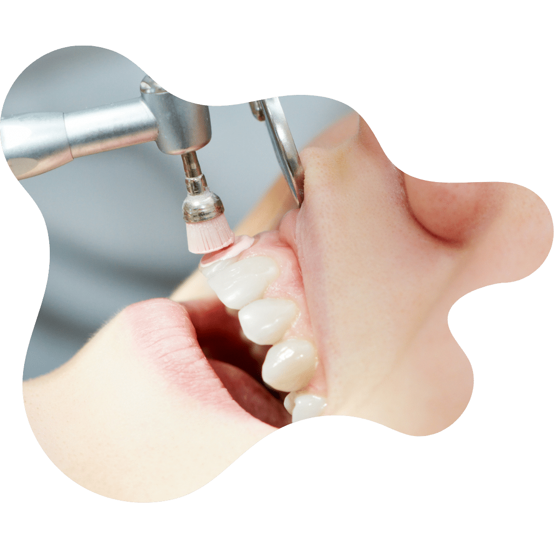 What Is Teeth Scaling and Polishing?
