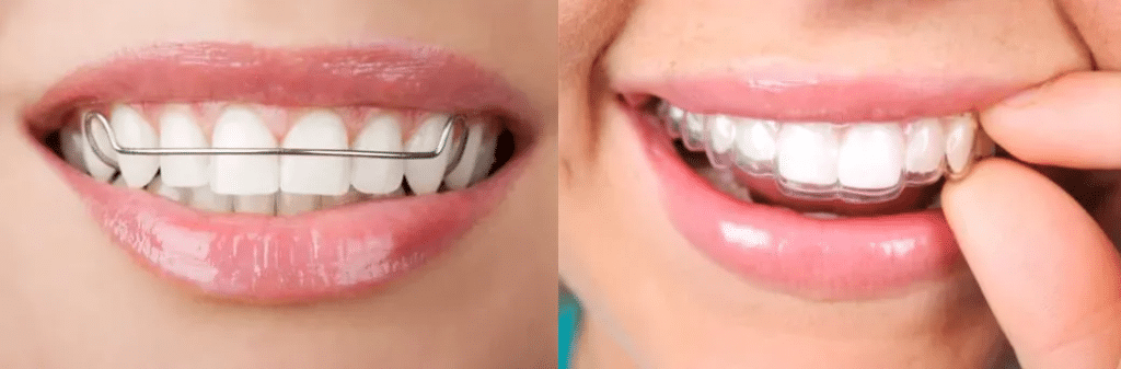 Dental Retainers Singapore