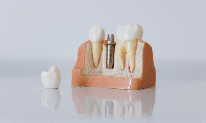 tooth implant