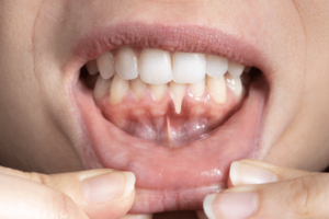 How to treat swollen gums