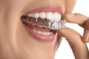 Teeth Grinding Treatment Singapore