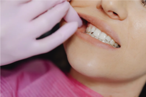 Teeth Grinding Treatment Singapore