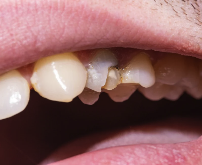 Chipped Tooth Repair in Singapore