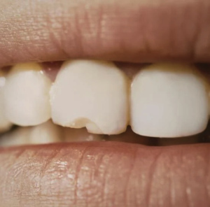 Chipped Tooth Repair in Singapore