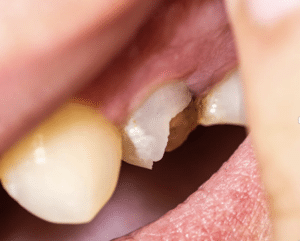 Chipped Tooth Repair in Singapore