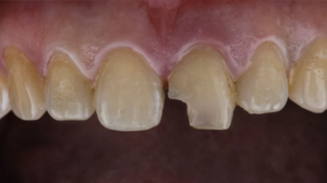 Chipped Tooth Repair in Singapore