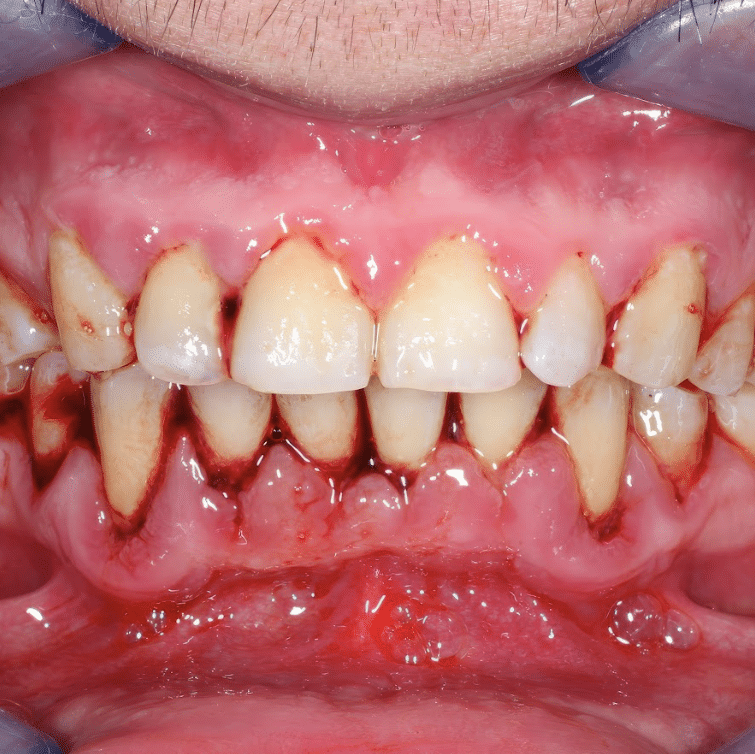 A Guide to Gum Disease Treatment in Singapore