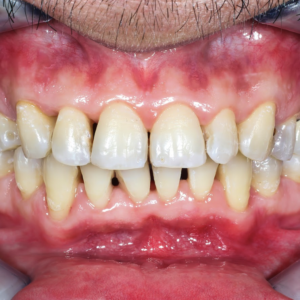 A Guide to Gum Disease Treatment in Singapore