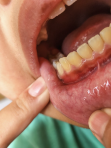 A Guide to Gum Disease Treatment in Singapore