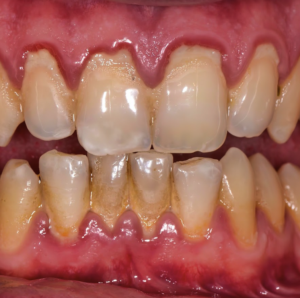 A Guide to Gum Disease Treatment in Singapore