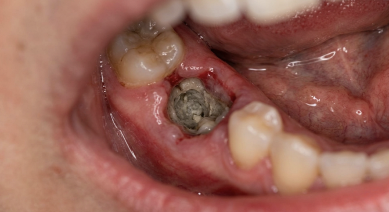 dry socket treatment singapore