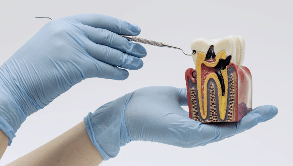 tooth cavity treatment guide in singapore