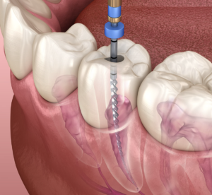 tooth cavity treatment guide in singapore