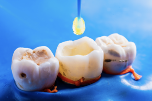 tooth cavity treatment guide in singapore