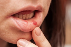 mouth ulcers causes and treatment in singapore