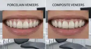 Side-by-side comparison of a patient's smile comparing the overall aesthetic results of composite bonding versus composite veneers.