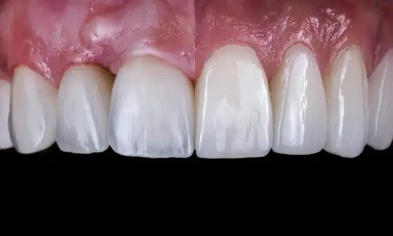 Macro side-by-side comparison image of upper front teeth, demonstrating the difference in coverage and shape between localized composite bonding on individual teeth and full-surface composite veneers.