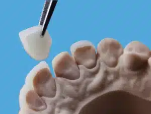 Dental tweezers placing a white dental crown onto a beige plaster model of human teeth.