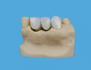 Side view of a realistic white dental bridge restoration mounted onto a beige dental model of gums and teeth, isolated against a solid blue background.