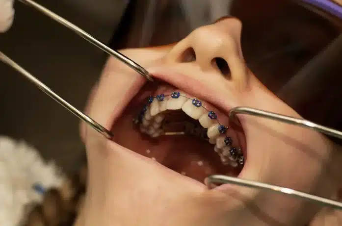 A Guide to Palate Expander in Singapore