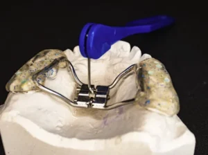 A Guide to Palate Expander in Singapore
