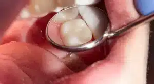 Dental Filling in Singapore: What Your Dentist Wants You to Know