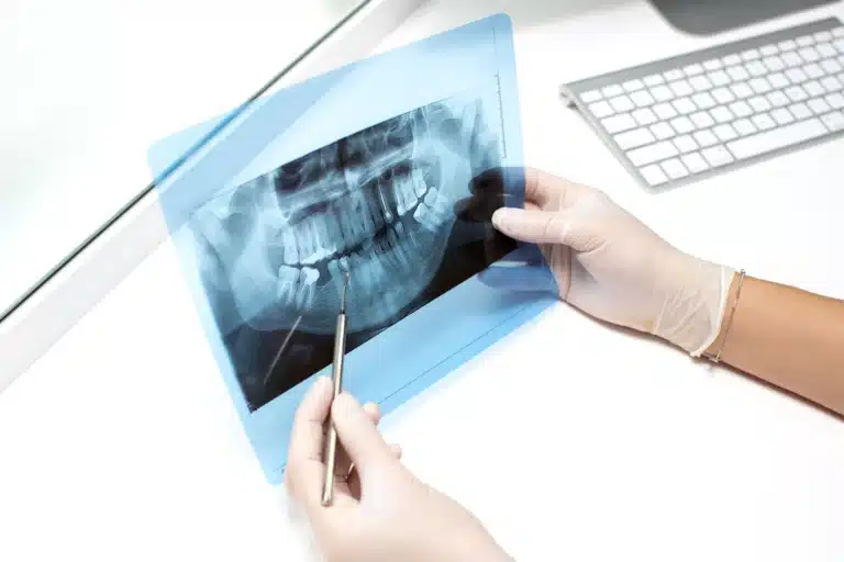 Dental Bone Graft Singapore