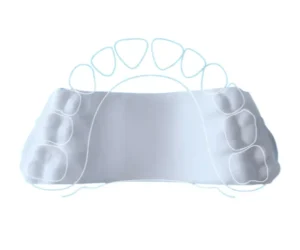 A Guide to Palate Expander in Singapore
