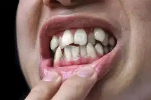 A Guide to Palate Expander in Singapore