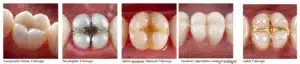 Dental Filling in Singapore: What Your Dentist Wants You to Know
