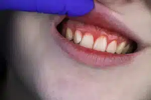 Close-up of inflamed, bleeding gums typical of gingivitis during pregnancy.