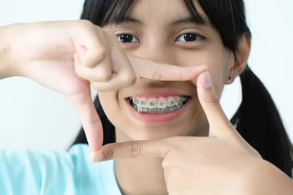 Girl showing off metal braces after knowing which foods to avoid with braces.