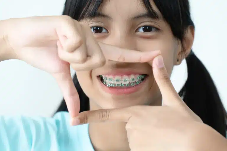 Girl showing off metal braces after knowing which foods to avoid with braces.