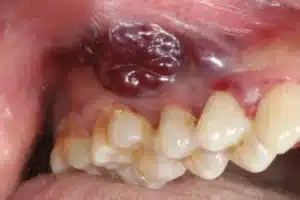 Close-up of an abnormal oral growth evaluated in an oral cancer screening in Singapore.