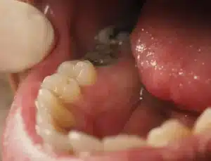 A person wincing in discomfort while holding her cheek, illustrating toothache pain.